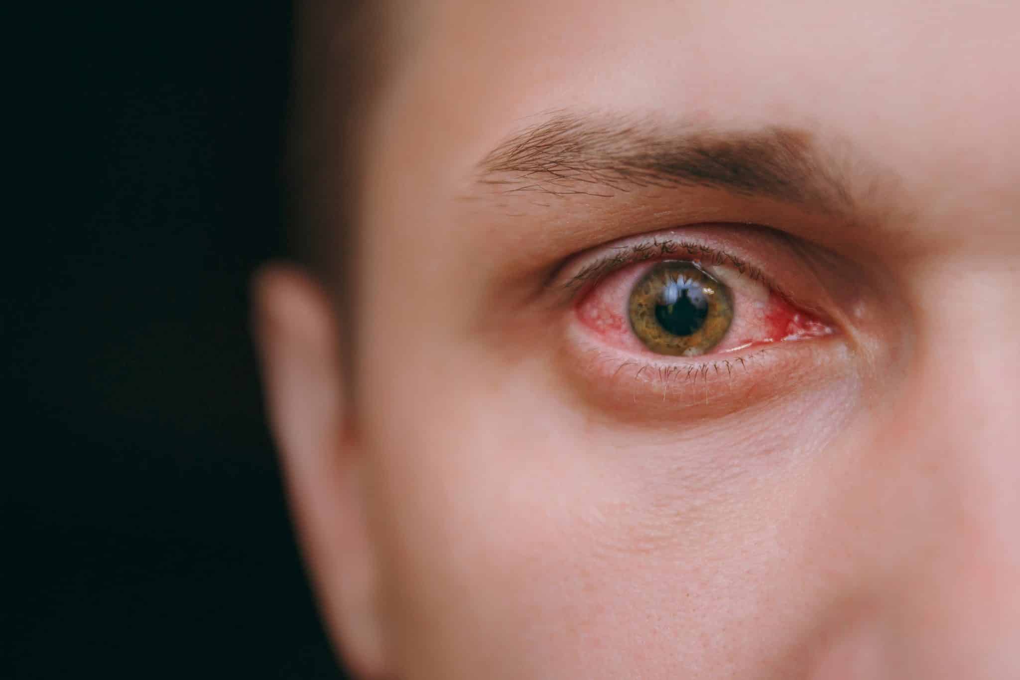 close,up,of,one,annoyed,red,blood,eye,of,male